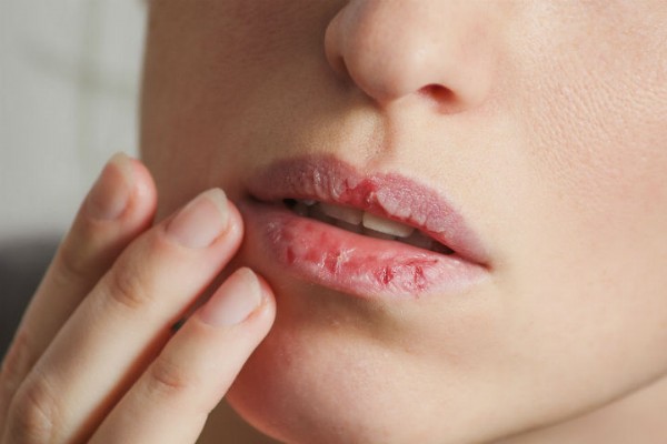 Dudak Çatlaması Neden Olur? Dudak Çatlaması Nasıl Geçer?